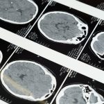 découvrez les dernières innovations et avancées en médecine du sport grâce à la technologie. explorez comment les outils et techniques modernes améliorent la performance, la récupération et la santé des athlètes.